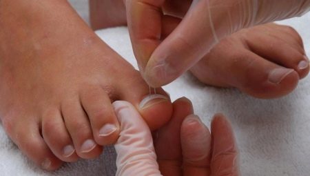 Ноктите на ноктите растат: причини и методи за лечение