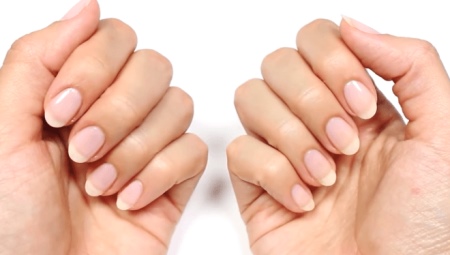 Pahuljasti nokti: uzroci, liječenje i prevencija